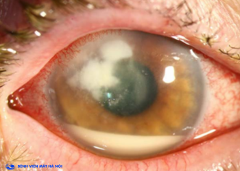 Bệnh viêm loét giác mạc