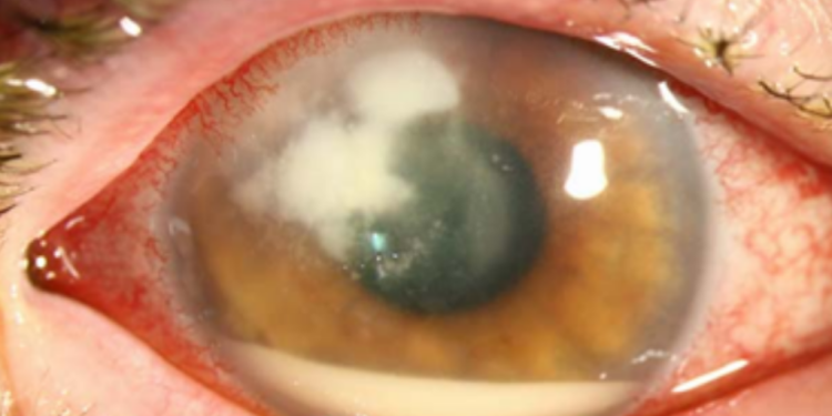 Bệnh viêm loét giác mạc