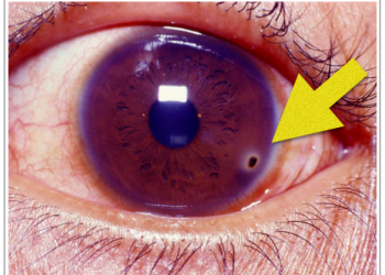 Chấn thương kết – giác mạc