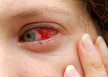 Xuất huyết mắt