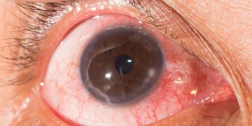 Bệnh viêm giác mạc