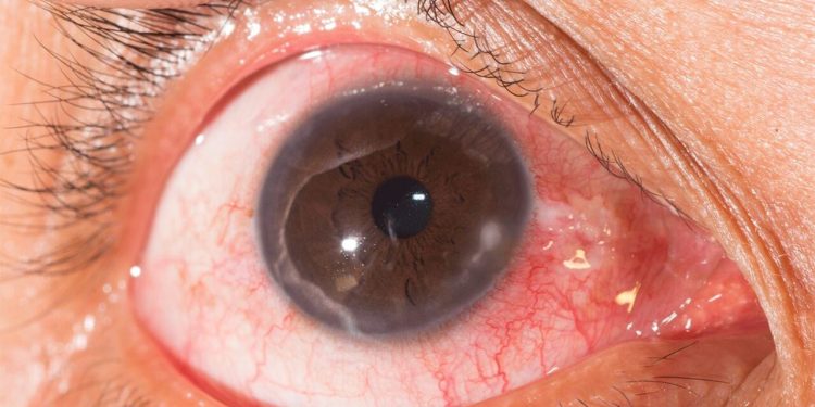 Bệnh viêm giác mạc