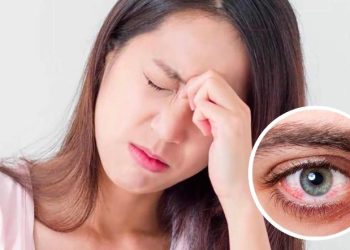 Các bệnh về mắt đặc biệt lưu ý