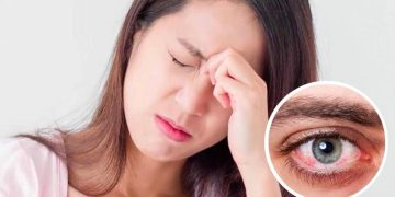 Các bệnh về mắt đặc biệt lưu ý