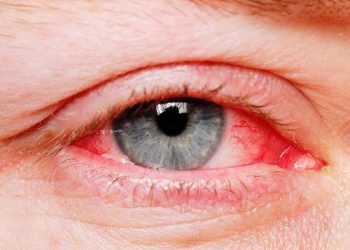 Bệnh viêm kết mạc