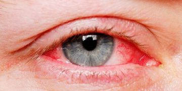 Bệnh viêm kết mạc