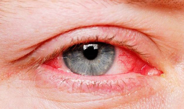 Bệnh viêm kết mạc