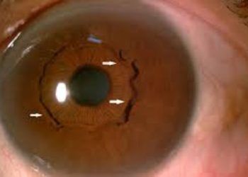 Bệnh Glôcôm (thiên đầu thống)