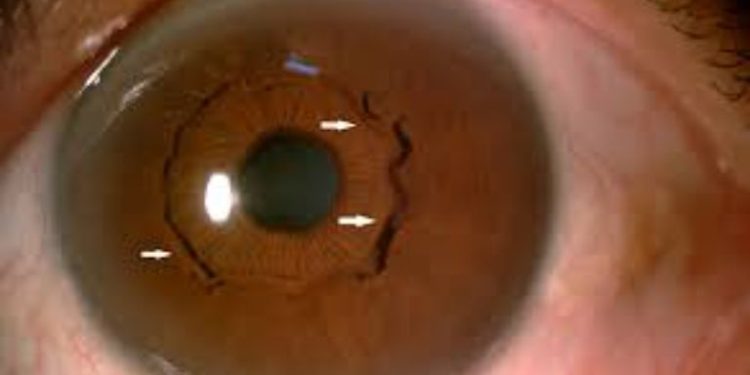 Bệnh Glôcôm (thiên đầu thống)